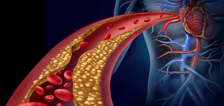 طبيب سعودي يحذر اصحاب الكولسترول المرتفع إيقافك للدواء يقودك لهذا الوضع!